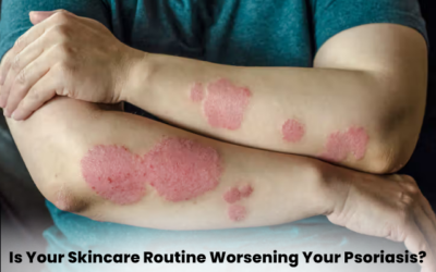 Is Your Skincare Routine Worsening Your Psoriasis?